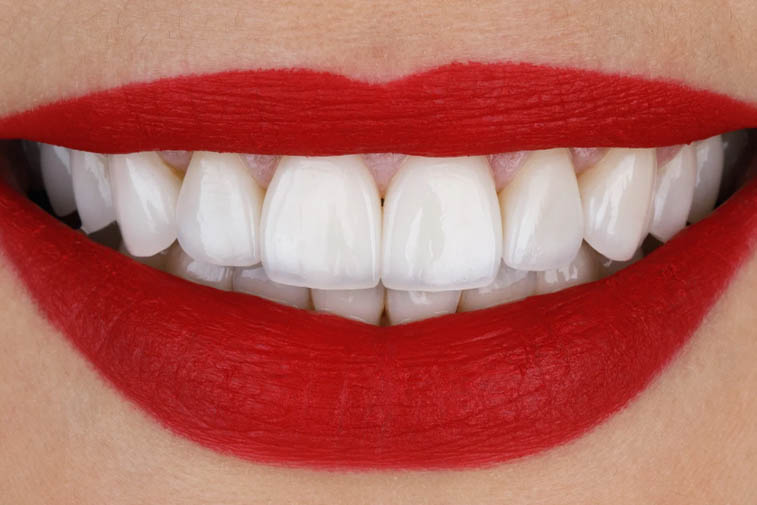 hollywood smile