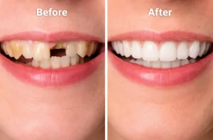 root canal before and after