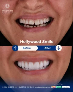 #hollywoodsmileإذا كنت تعاني من تصبغات، فراغات بسيطة، أو عدم تناسق في شكل الأسنان، ابتسامة هولي