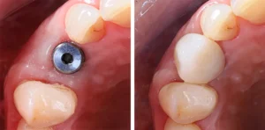 implant and crown